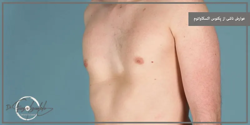 عوارض ناشی از پکتوس اکسکاواتوم