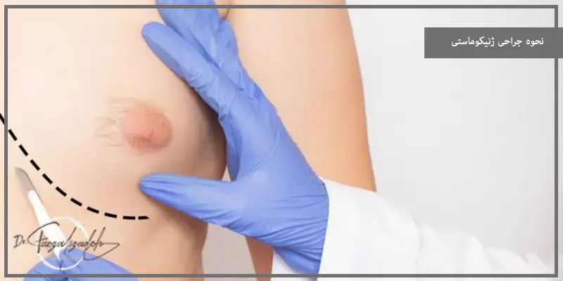 نحوه جراحی ژنیکوماستی