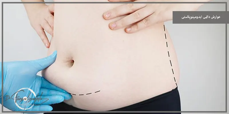 عوارض دائمی ابدومینوپلاستی